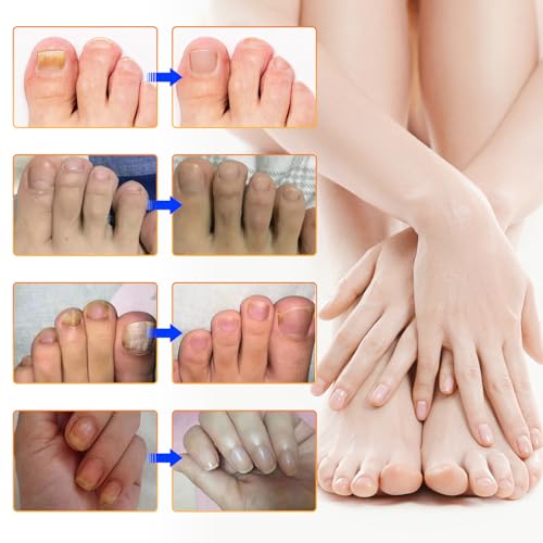 Toenail Treatment Extra Strength-8-Hrs Overnight Nail Repair,ingrown toenail treatment,Strengthens Brittle Nails,Improves Texture & Thickening Hypoallergenic Easy (2 pack 64 Patch)
