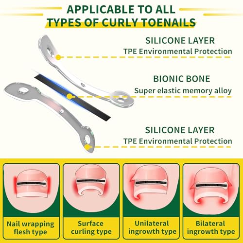 Titanium Alloy Ingrown Toenail Treatment & Removal Kit for Quick Relief, Ingrown Toenail Removal Kit， Professional Ingrown Toenail Corrector, Ingrown Toenail Tools for Quick Relief, 10 Pcs